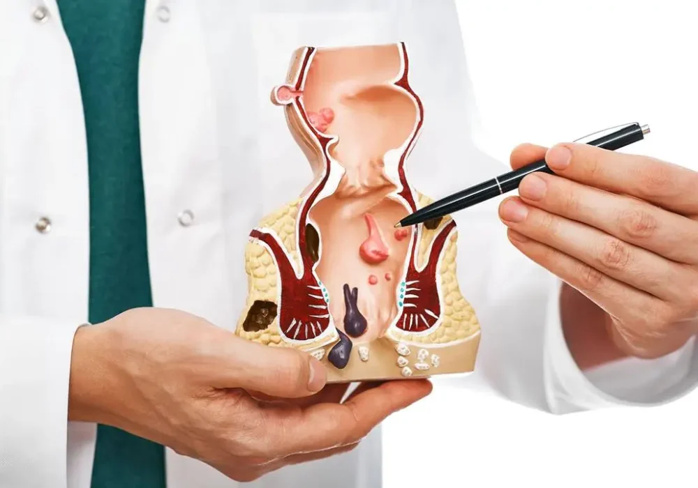Fistula-treatment-in-Chembur